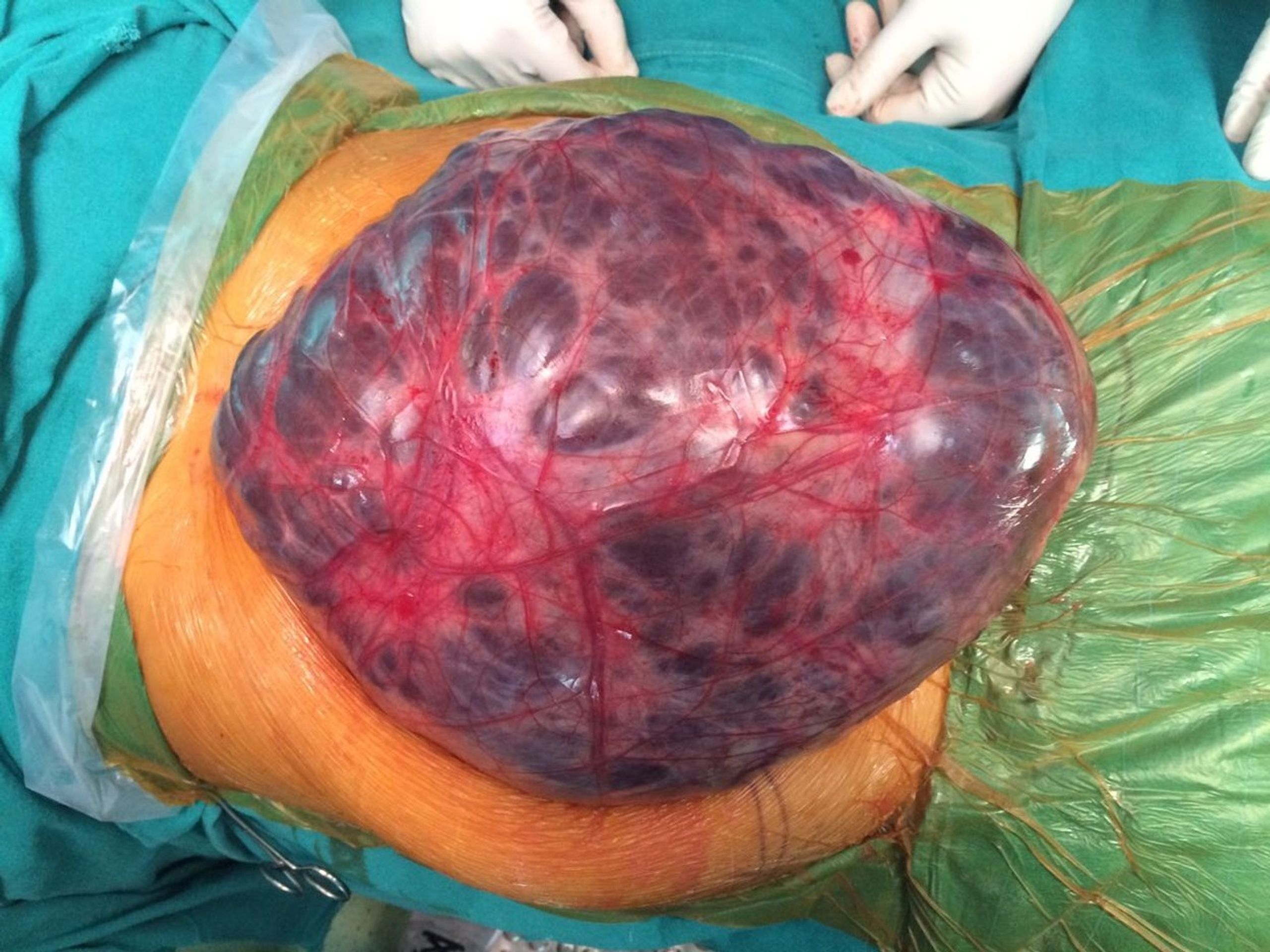 Ženě odstranili nádor vážící 7kg - 1 - GALERIE: Ženě odstranili nádor vážící 7kg (1/5)