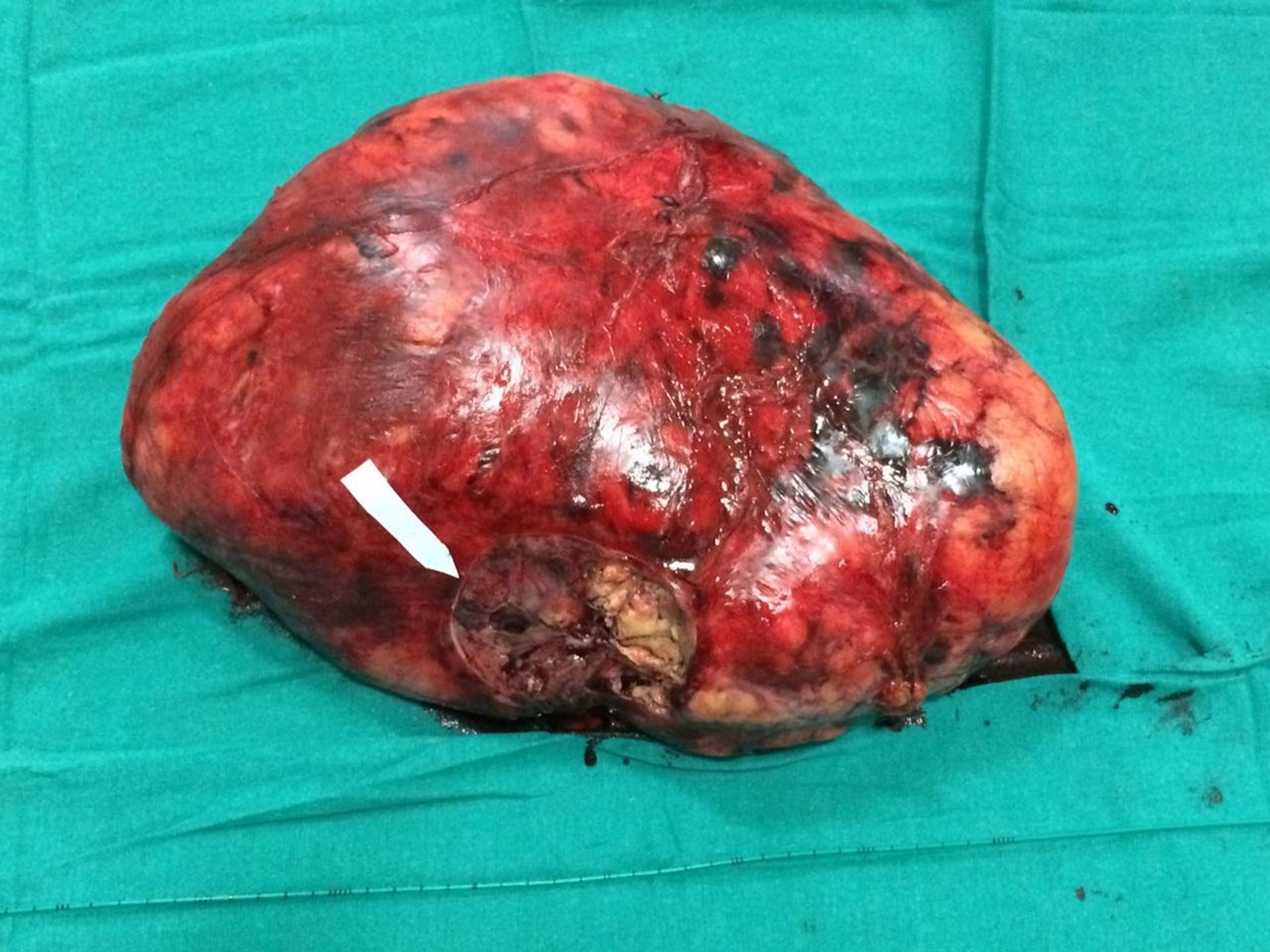 Ženě odstranili nádor vážící 7kg - 4 - GALERIE: Ženě odstranili nádor vážící 7kg (4/5)