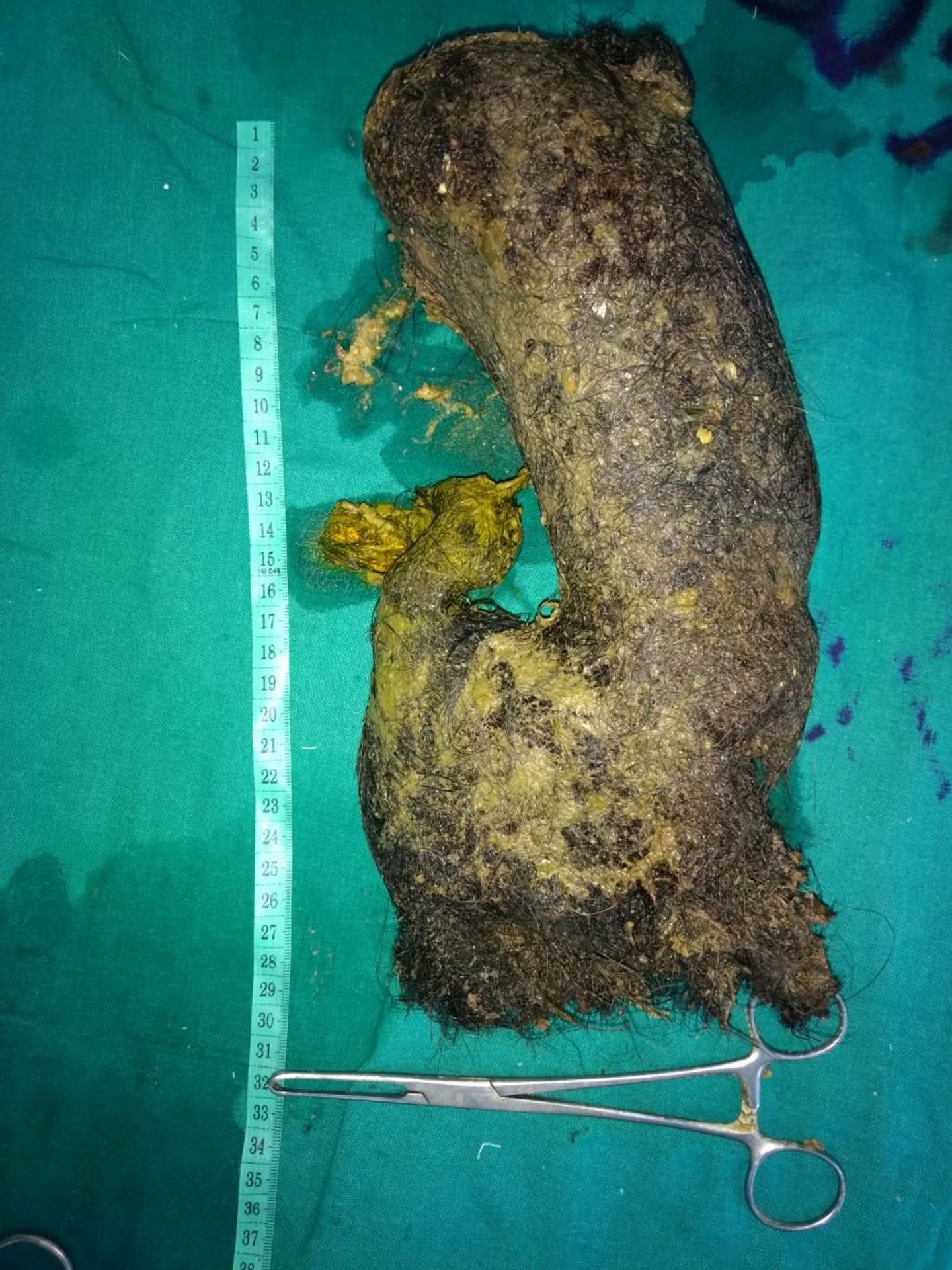 Ženě vyndali z žaludku 1,3 kilogramu vlasů - GALERIE: Lékaři vyndali ženě z žaludku přes kilo vlasů, muži kila železa (3/4)