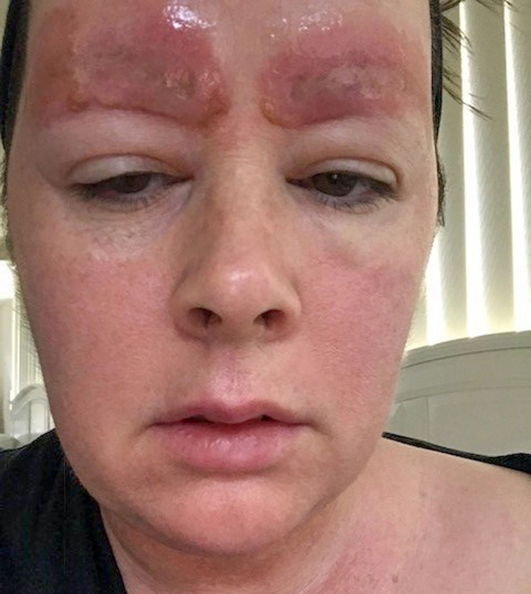 Žena si nechala vytetovat obočí. Poté si prošla peklem - 1 - GALERIE: Žena má po tetování popáleniny (4/4)