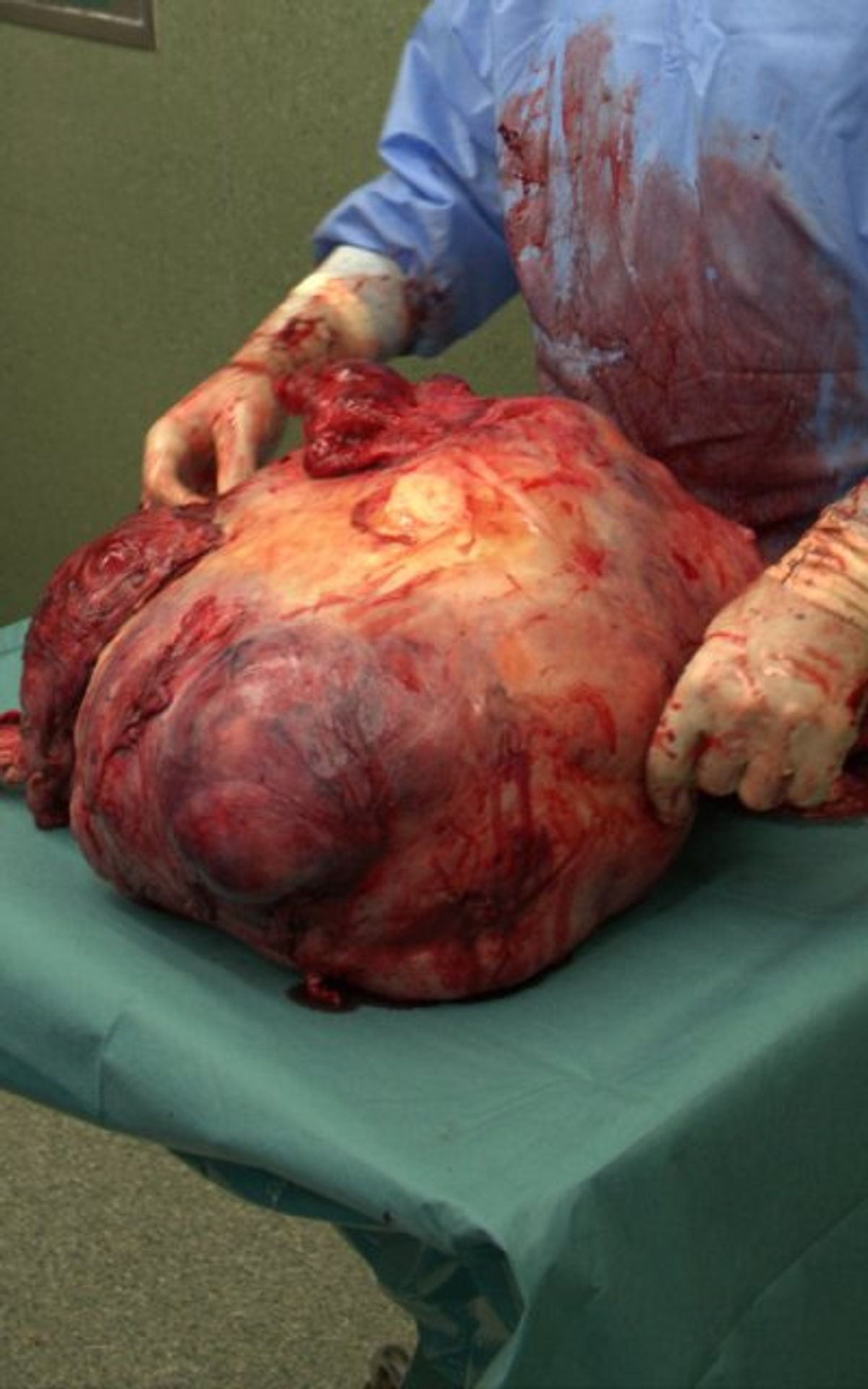 Obří nádor, který vyoperovali ve Zlíně - GALERIE: Ženě ve Zlíně vyoperovali nádor, který vážil 36 kg (2/2)