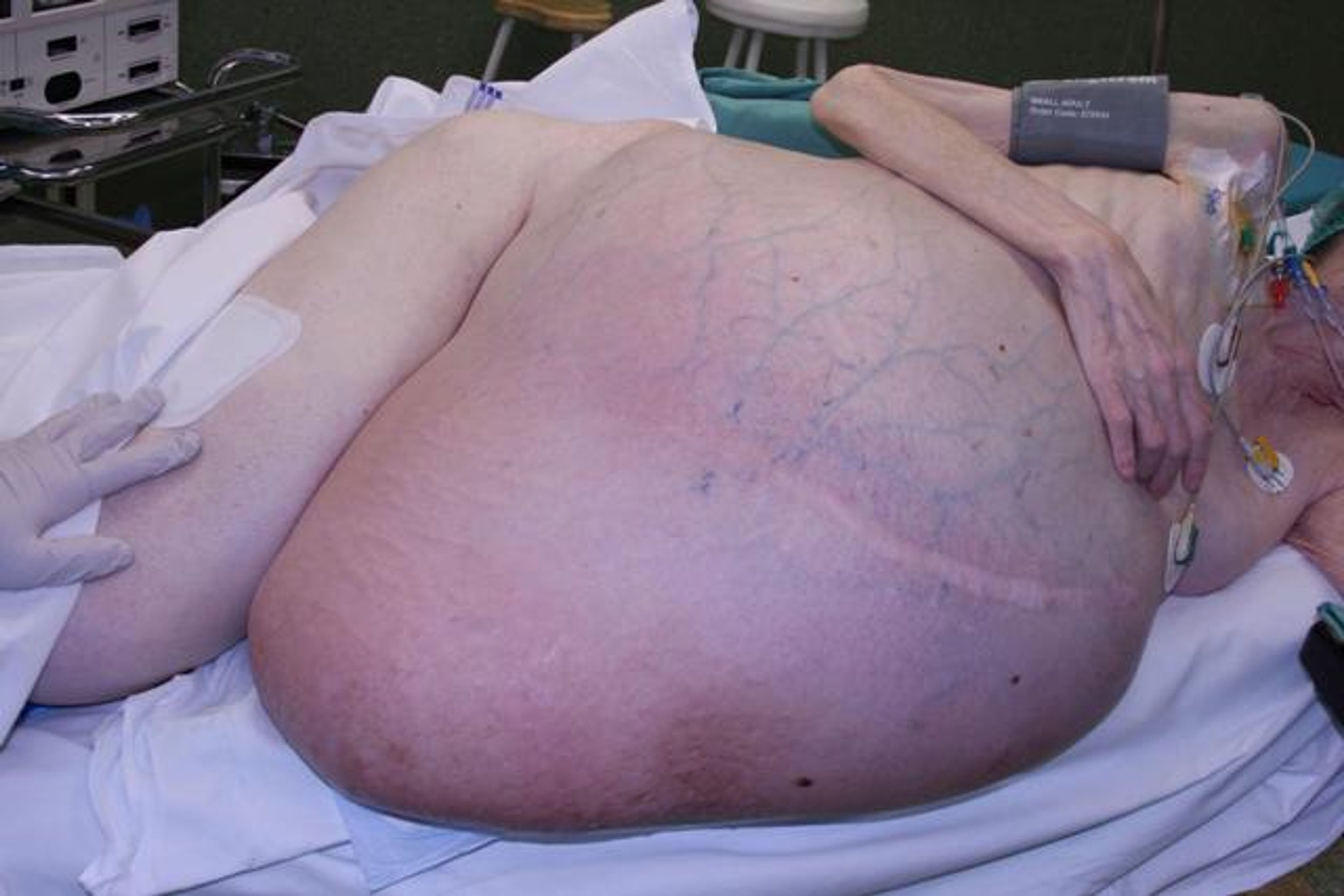 Obří nádor, který vyoperovali ve Zlíně - GALERIE: Ženě ve Zlíně vyoperovali nádor, který vážil 36 kg (1/2)