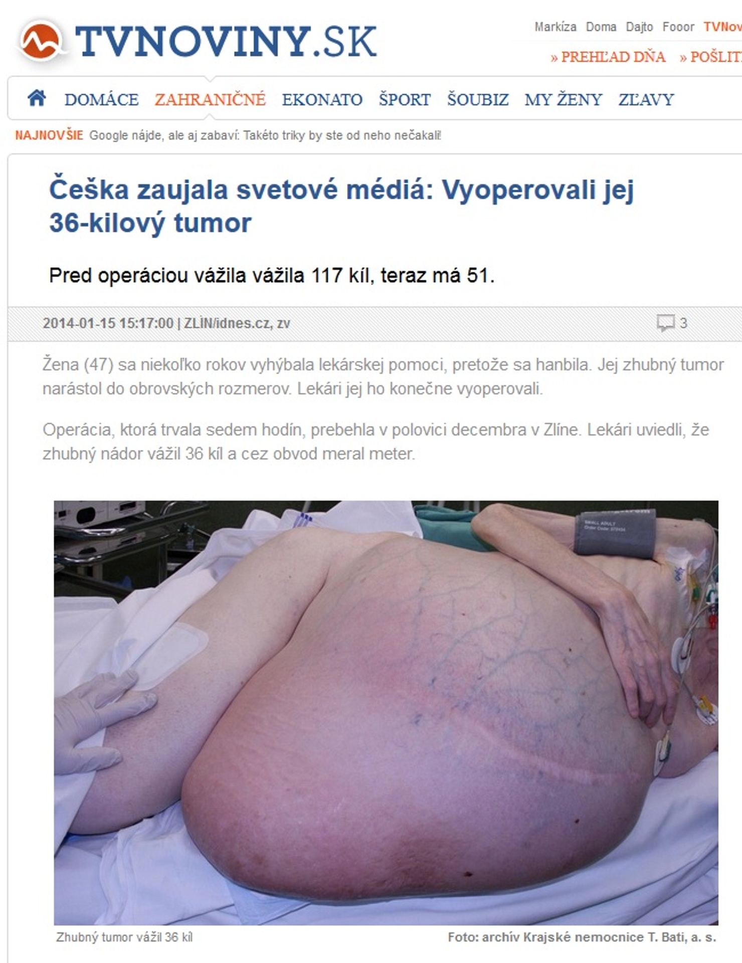 Obří nádor z Česka na TVnoviny.sk - GALERIE: Obří nádor zaujal svět (2/4)