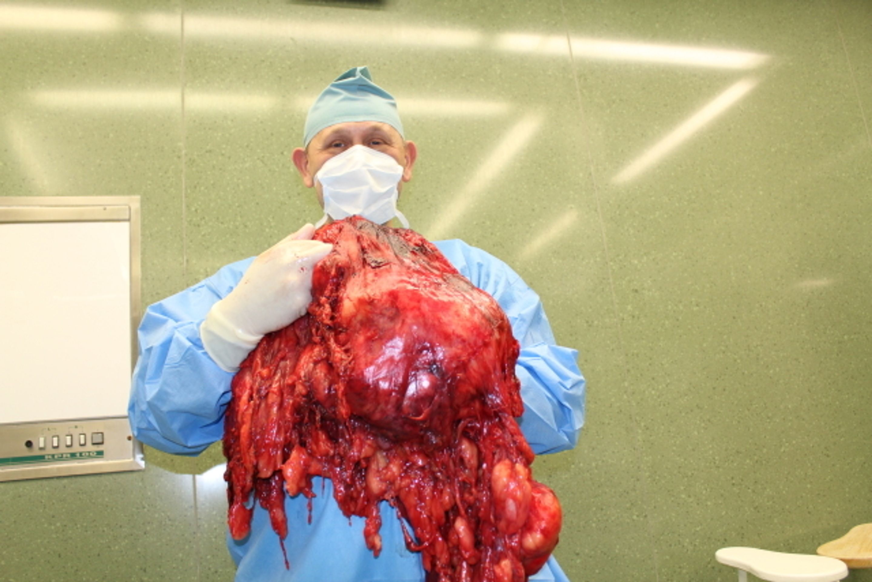 Zlínští lékaři vyoperovali obří nádor - 3 - GALERIE: Zlínští lékaři vyoperovali 27kilový nádor (4/4)