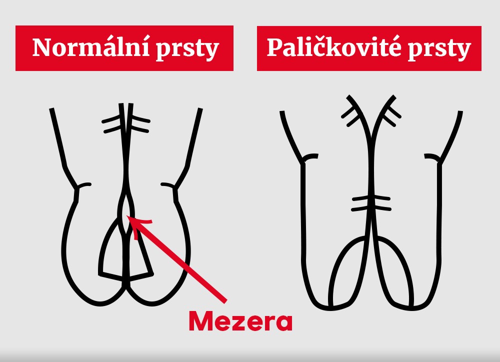 Rozdíl mezi normálními a paličkovitými prsty