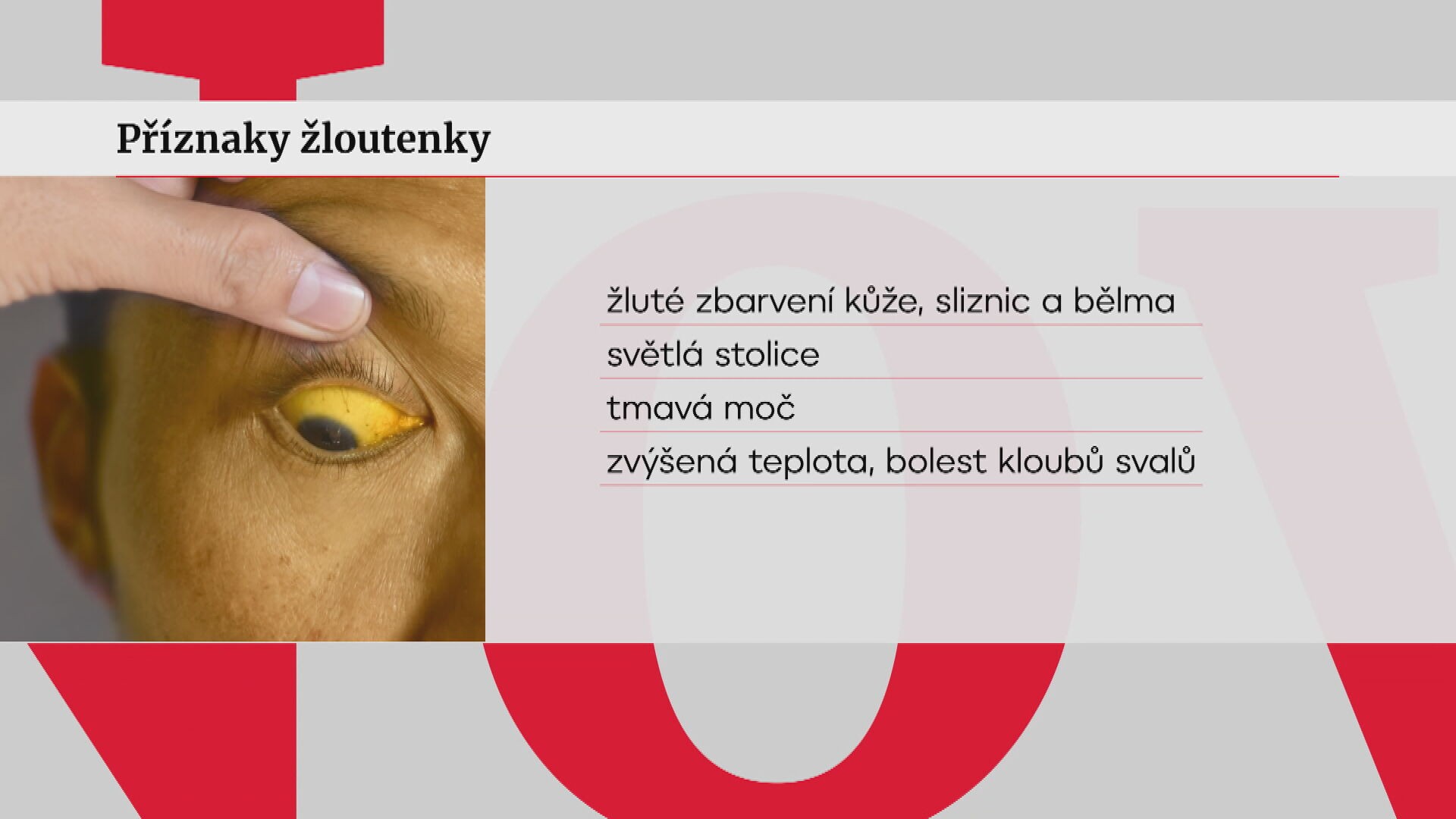 Příznaky žloutenky